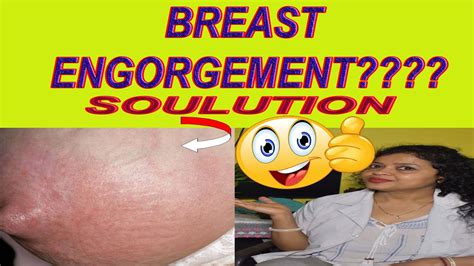 Quick BREAST ENGORGEMENT Solution And Prevention Treatment In Easy Way YouTube