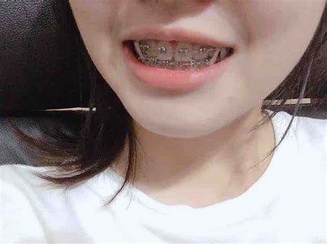 Retainers Orthodontics Braces Lp Close Up Mouth Beautiful