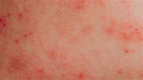 Encuesta Sobre Dermatitis Atópica Por Qué Es Mucho Más Que Una