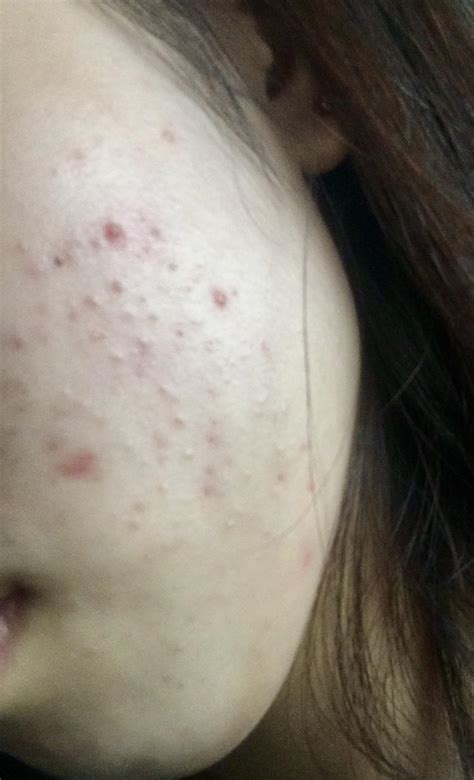 Skin Concern Are These Small Bumps On My Cheeks Closed Comedones Or