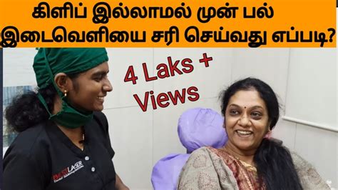 0 yrs old female asked about teeth gap problem, 12 doctors answered this and 3363 people found it useful. முன் பல் இடைவெளியை கிளிப் இல்லாமல் சரி செய்வது எப்படி?How ...