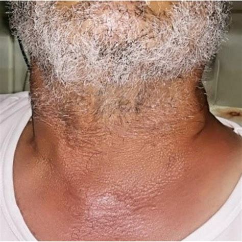 Picture Of The Patients Neck Showing Left Sided Swelling Without