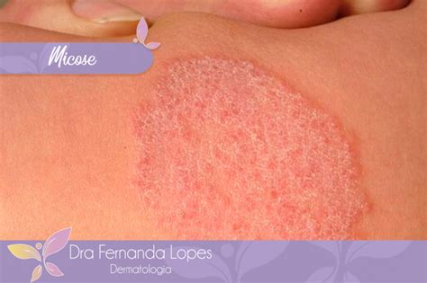 Dra Fernanda Lopes Dermatologia Blog Micose
