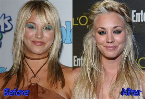 Kaley Cuoco Before And After Plastic Surgery
