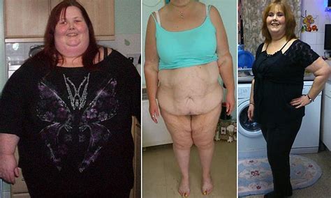 Morbidly Obese Woman Who Lost 18 Stone Reveals Her Saggy Skin Daily Mail Online