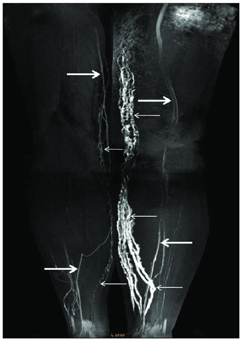 Contrast Enhanced 3d Mrl Image Of The Lower Extremities Coronal 3d Mr