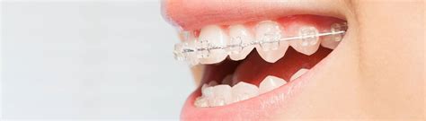 Empower Self Ligating Braces Empower Braces In The Woodlands Tx