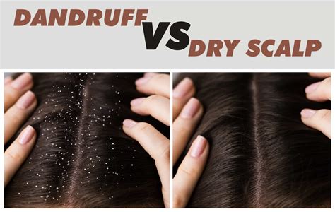 Dandruff Vs Dry Scalp 5 Crucial Things You Must Know