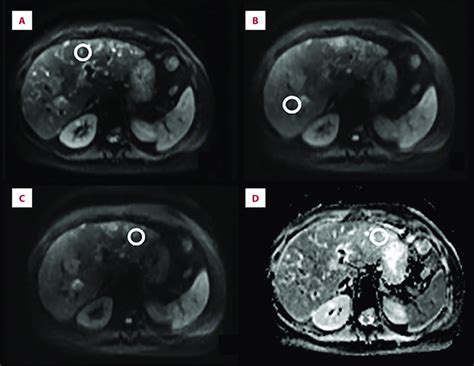 A D Mr Axial Diffusion Weighted Imaging Dwi Scans Dilated