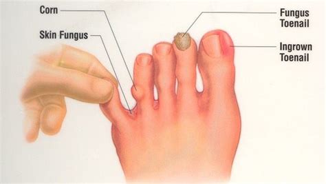 28 Tips On How To Stop Ingrown Toenails From Coming Back