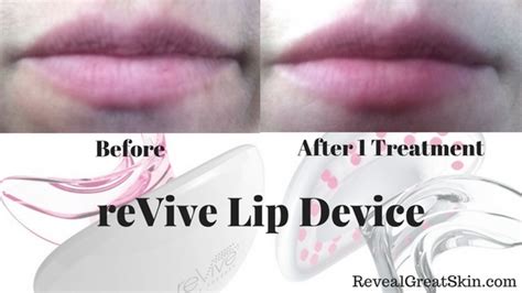 Revive Lip Device Plumps Your Lips Effortlessly Reveal Great Skin