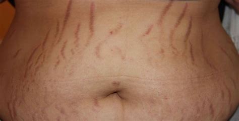Causes Of Stretch Marks Types Treatments And Home Remedies