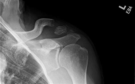 Ortho Dx Shoulder Pain Following A Tractor Accident Clinical Advisor