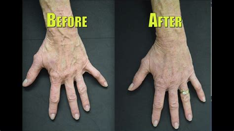 Rejuvenate Your Hands By Fixing Bulging Veins
