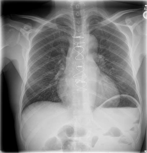 Normal Thoracic X Ray