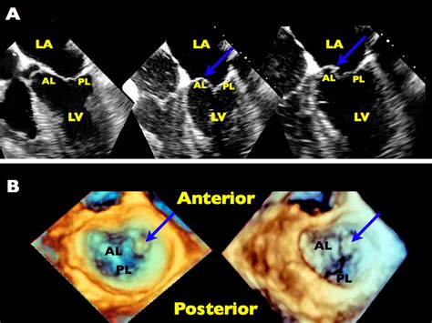 Mitral Valve Repair An Echocardiographic Review Part 2 Journal Of