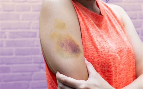 6 Health Problems That Can Cause Bruises On Your Body Beautyhealthycare