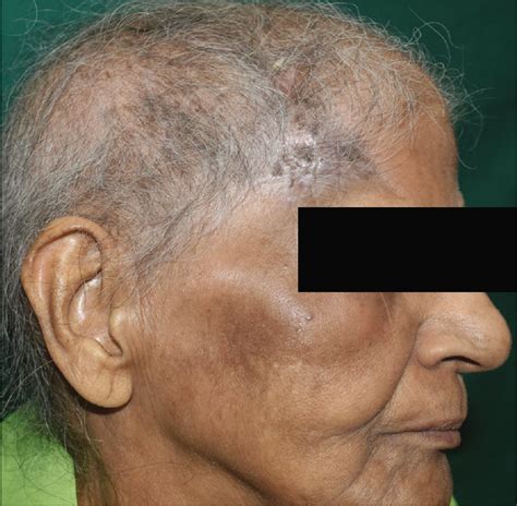 Blood Filled Masses On Scalp In A Middle Aged Woman Indian Journal Of