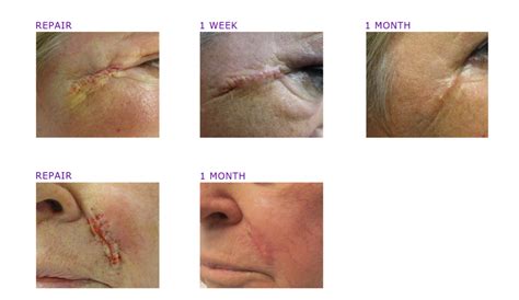 Mohs Surgery Photos Before And After Adc Derm