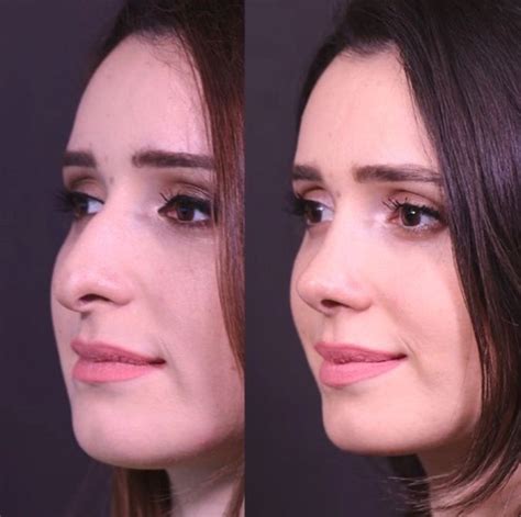 Nose Plastic Surgery Nose Surgery Skin Nova Facial Procedure Amazing Wedding Makeup