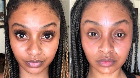 Microneedling On African American Skin Maura Beauty Youtube