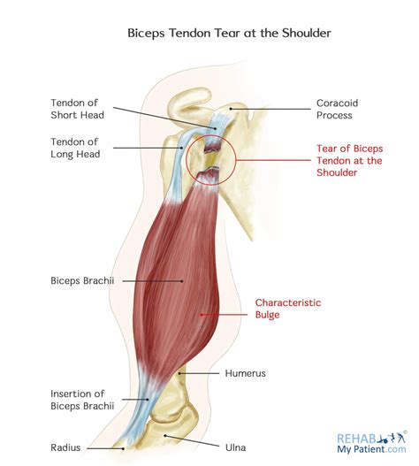Biceps Tendon Tear At The Shoulder Rehab My Patient