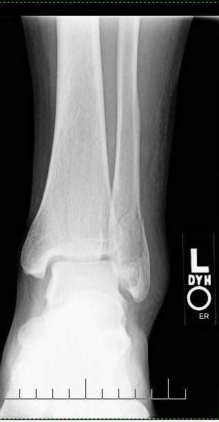 Pre Op Ankle Fracture Advanced Foot And Ankle Center Of San Diego