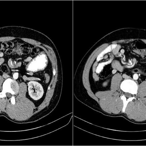 Abnormal Position Of Cecum And Appendix Download Scientific Diagram