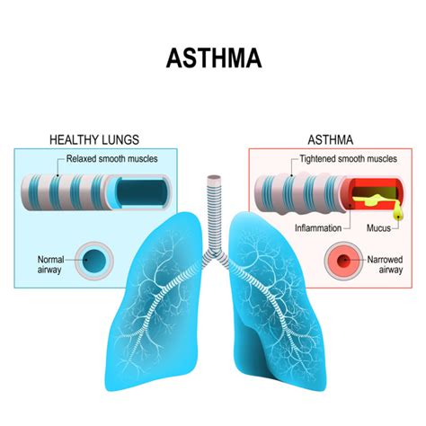 Relationship Of Asthma And Allergies Colorado Allergy And Asthma Centers P C