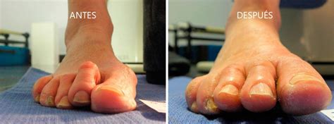 Cirugía del pie en juanetes y dedos en garra Clínica Piqueras