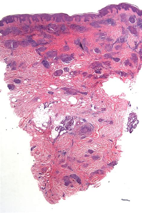 Sarcoidosis Cutaneous Sarcoidosis The Clinical Advisor