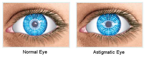 What Is Astigmatism Infographic Portal