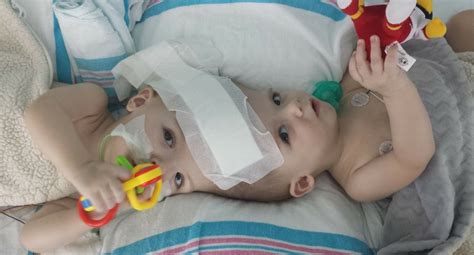 Conjoined Twins Undergo Marathon Surgery To Separate Them Thats Life