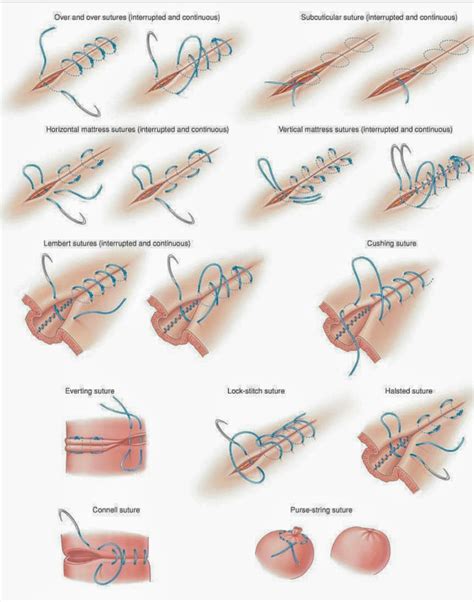 Different Types Of Surgical Suturing Techniques Medizzy