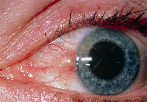 Close Up Of Eye Showing Inflamed Pinguecula Stock Image M1550331