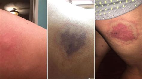 Reddit User Shares Photos Of One Womans Recovery From