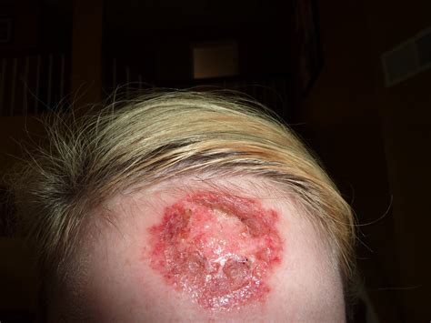 They are very minute observers and will completely take in everything in their these are the very parameters they measure and sense the world with. Adventures of Team Kelso: This is what skin cancer looks like