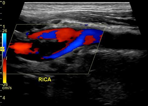 Carotid Artery Dissection Imaging Findings On Multi Parametric