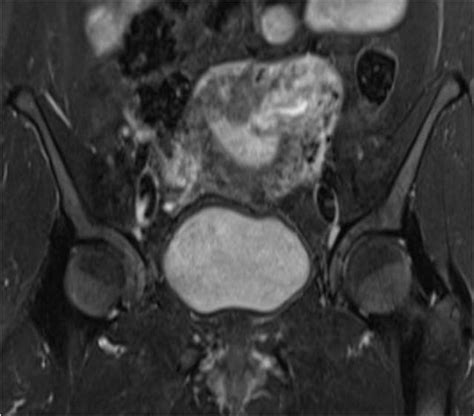 Cornual Ectopic Pregnancy Laparoscopic Management Step By Step Bmj