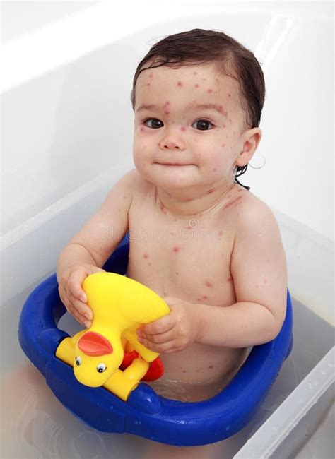 Baby Bath Suffering Chicken Pox Stock Photos Free And Royalty Free