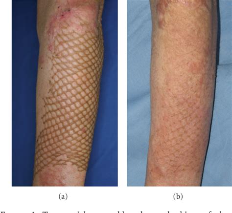 Figure 1 From Treatment Of Mesh Skin Grafted Scars Using A Plasma Skin