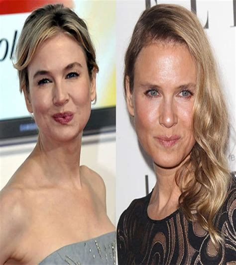 60 Worst Cases Of Celebrity Plastic Surgery Gone Wrong 8E9