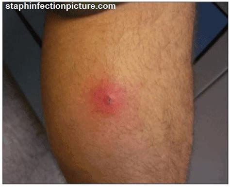 Pin On Staph Infection