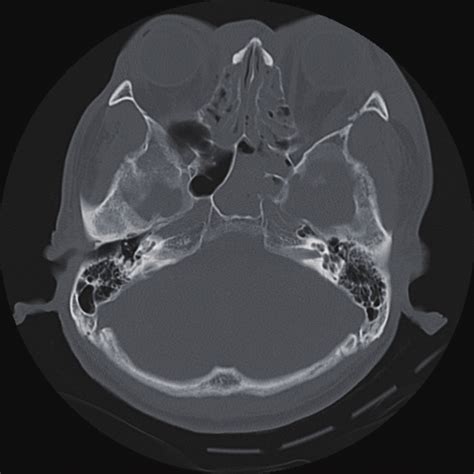 Computed Tomography Of The Facial Bone Showing A Sphenoid Sinus