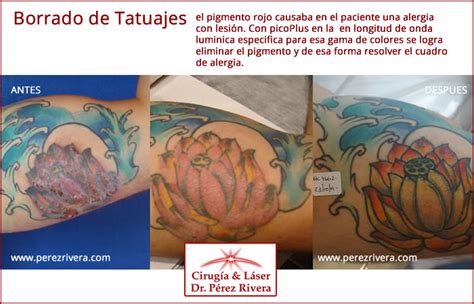 Tatuajes Que Generan Alergia Spectra™ Tattoo Laser