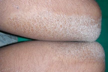 Dry Scaly Skin Patches On Elbows