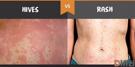 Hives Rash How To Tell The Difference Off