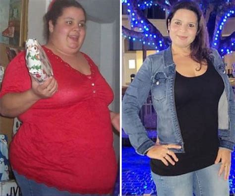 Weight Loss Surgery Before And After Moon Gastric Sleeve