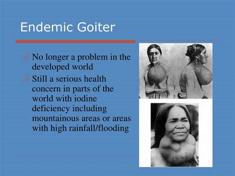 Ppt Thyroid Gland Diseases Powerpoint Presentation Free Download