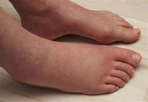 What To Know About Swollen Feet University Health News
